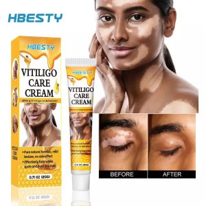 HBESTY Vitiligo Care Cream